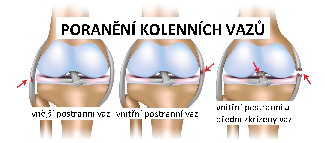 knee_ligam_injuries1083